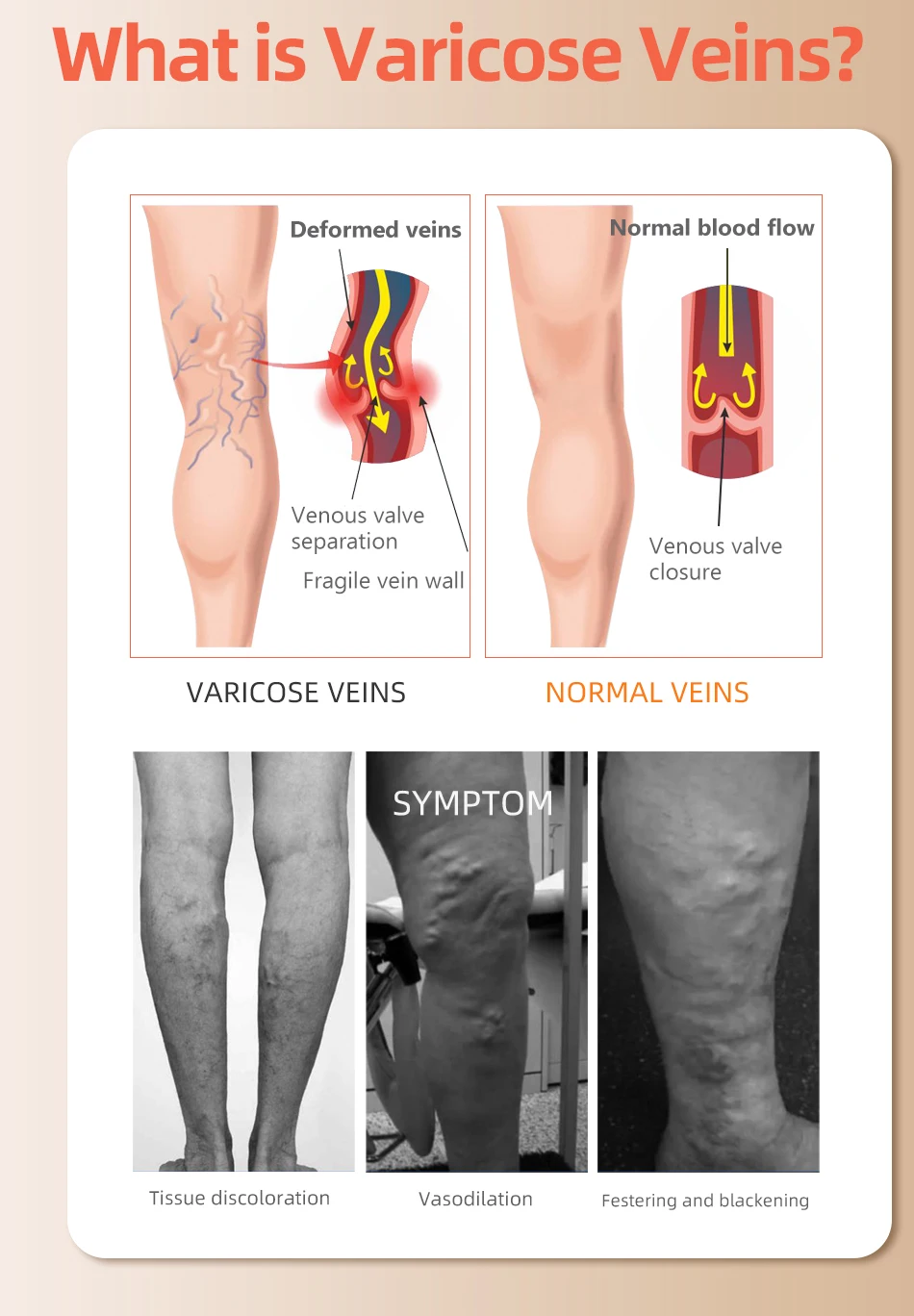 30-40 MmHg Over de Knie Geslot - Compression Sock Medical recensie en prijs